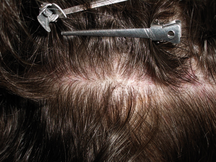 Cicatrice Trapianto Capelli