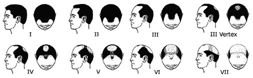 Trapianto di Capelli Uomo