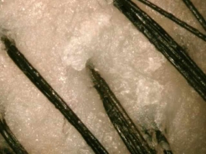 Dermatite Capelli