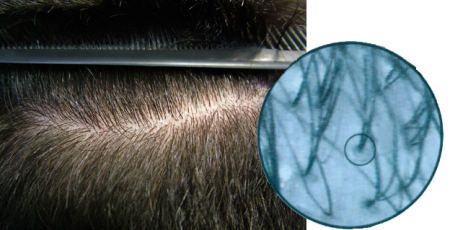 Trapianto di Capelli